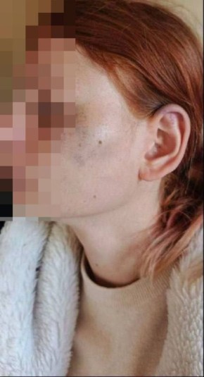 Так выглядит сейчас девочка-инвалид, избитая подростками в Макеевке